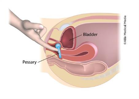 Urinary Incontinence