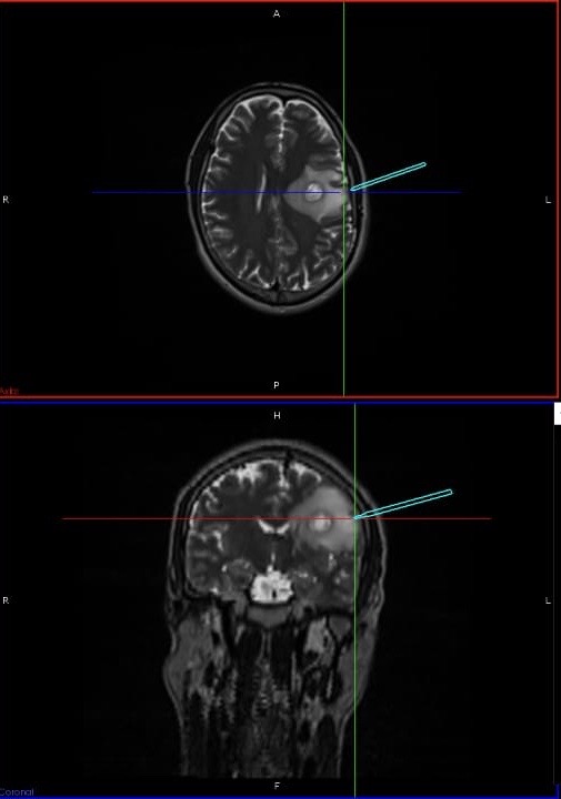Tracker showing exact point of entry