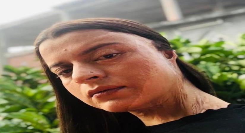 Bollywood star Kangana Ranaut's sister Rangoli Chandel has revealed details of the gruesome acid attack she fell victim to, on twitter.