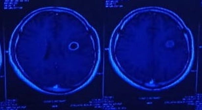Ring enhancing lesion