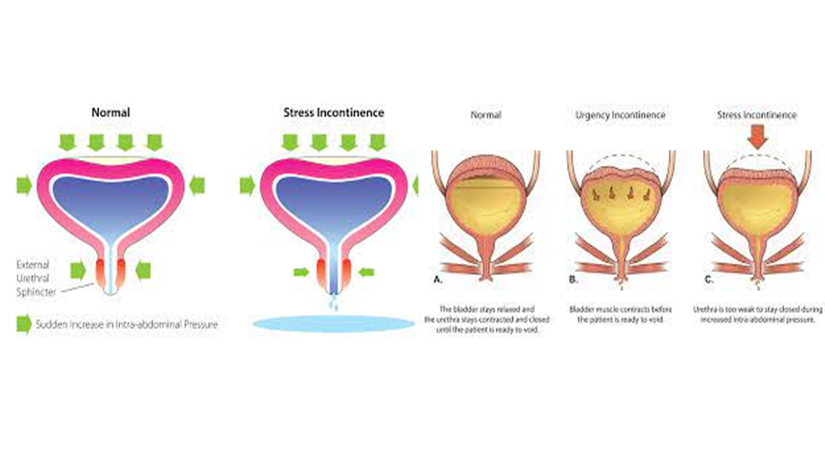 Urinary Incontinence