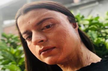 Bollywood star Kangana Ranaut's sister Rangoli Chandel has revealed details of the gruesome acid attack she fell victim to, on twitter.
