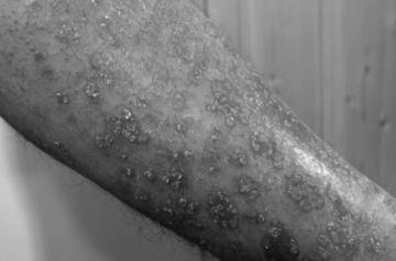 Psoriasis