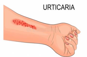 Urticaria
