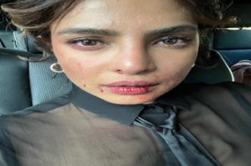 Priyanka Chopra shares picture of 'bruised' face from 'Citadel' set.(photo:Instagram)